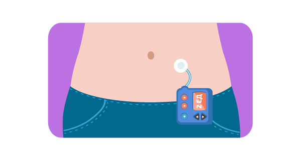 Школа диабета  1 типа. Что такое помповая инсулинотерапия?