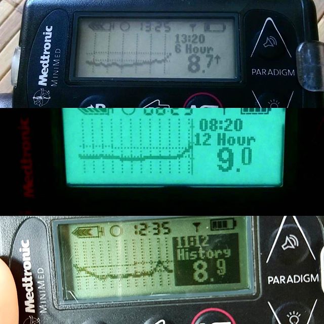 Сахарный диабет 1 типа. Тренды мониторинга