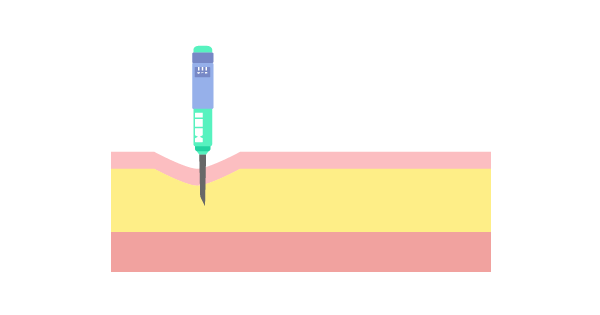 Школа диабета 5.1 Игла 4–5–6 мм