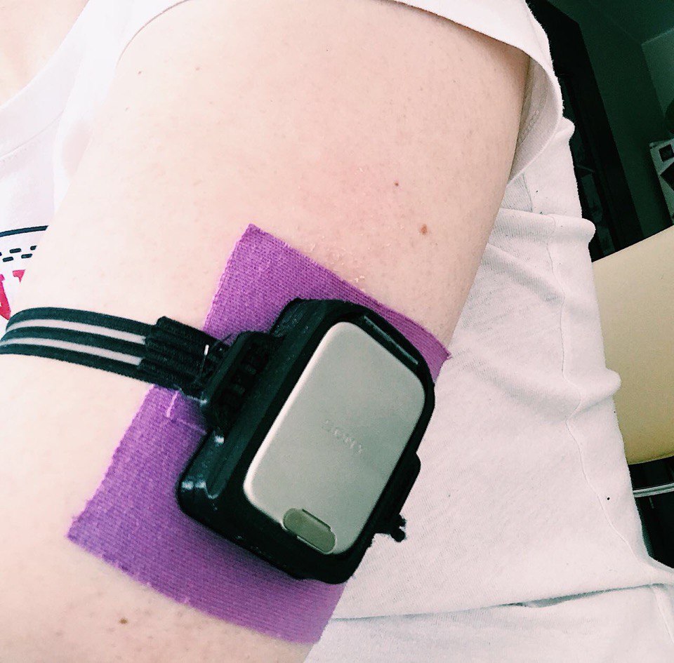 Организация CGM на основе сенсора Freestyle Libre. Диабет, сахарный диабет, СД1 типа, СД 2 типа, Правило 15.