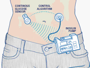 http://www.mayo.edu/research/~/media/kcms/gbs/research/images/2013/03/07/14/54/de11-2-artificial-pancreas-diagram.ashx