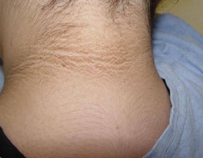 Сахарный диабет 2 типа у детей и подростков. Диабет, сахарный диабет, СД1 типа, СД 2 типа, Правило 15.