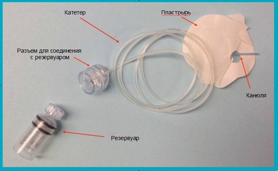 Рис.1 Строение инфузионной системы (1) Инфузионные системы для постоянной подкожной инфузии инсулина (ППИИ)..Диабет, сахарный диабет, СД1 типа, СД 2 типа, Правило 15.