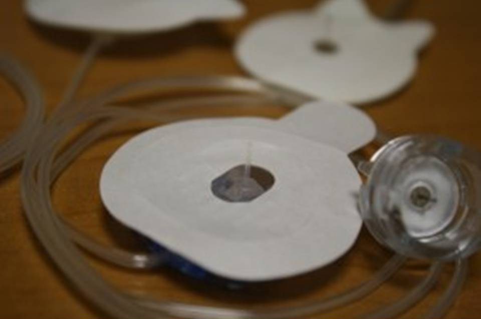 Инфузионные системы для постоянной подкожной инфузии инсулина (ППИИ)..Диабет, сахарный диабет, СД1 типа, СД 2 типа, Правило 15.