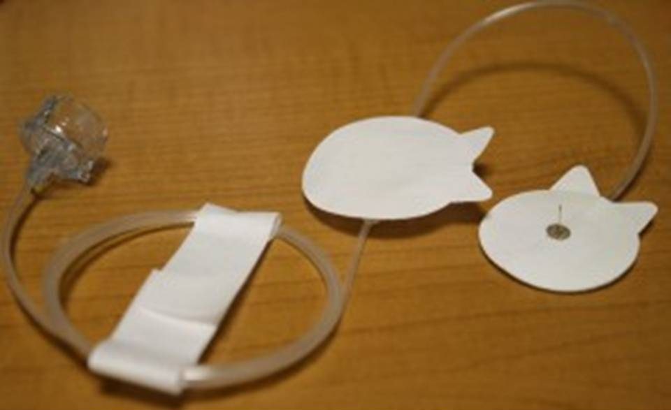 Инфузионные системы для постоянной подкожной инфузии инсулина (ППИИ)..Диабет, сахарный диабет, СД1 типа, СД 2 типа, Правило 15.