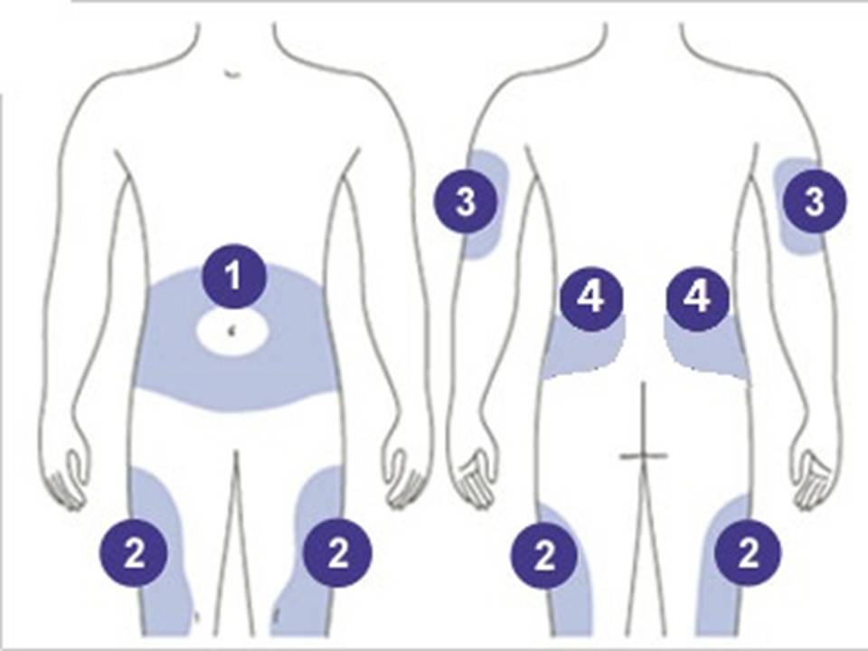 Инфузионные системы для постоянной подкожной инфузии инсулина (ППИИ)..Диабет, сахарный диабет, СД1 типа, СД 2 типа, Правило 15.