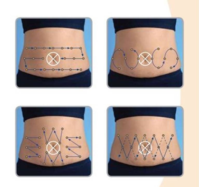 Инфузионные системы для постоянной подкожной инфузии инсулина (ППИИ)..Диабет, сахарный диабет, СД1 типа, СД 2 типа, Правило 15.