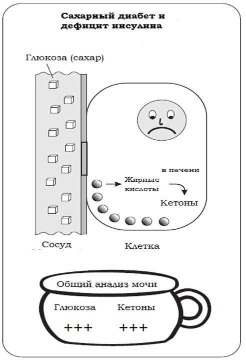Инсулин и его значение для организма.Диабет, сахарный диабет, СД1 типа, СД 2 типа, Правило 15.